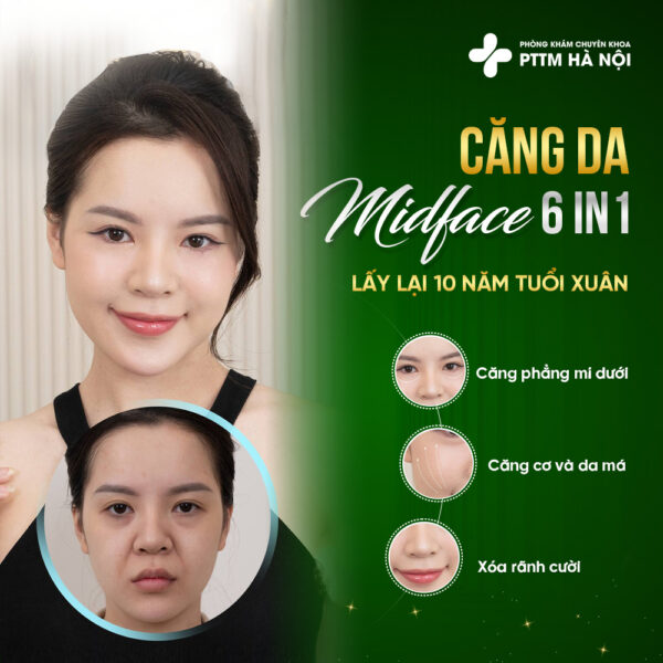 căng da Midface 6in1 giúp lấy lại 10 năm tuổi xuân tại phòng khám thẩm mỹ Hà Nội
