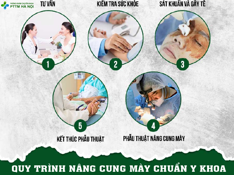 Quy trình nâng cung mày chuẩn y khoa