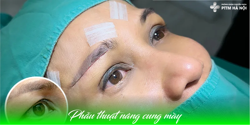 Nâng Cung Mày Bằng Phẫu Thuật Truyền Thống