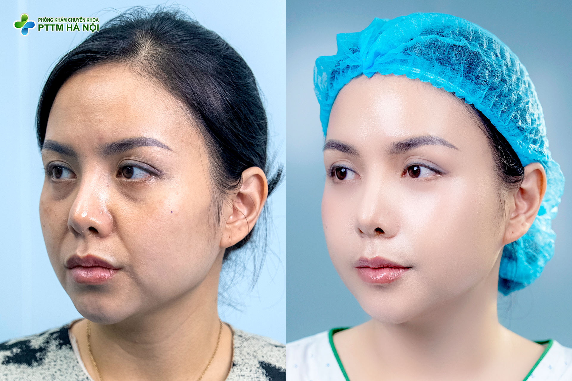 Lão hóa không còn là nỗi lo: Giải pháp căng da midface chuẩn y khoa