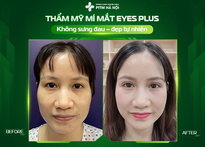 Hình ảnh trước và sau cắt mí sau 7 ngày hồi phục