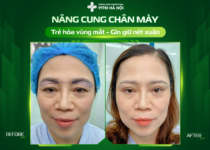 Trước và sau nâng cung mày giúp thay đổi diện mạo gương mặt