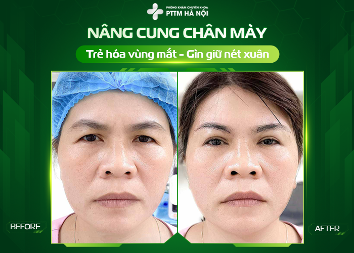 Kết quả nâng cung mày sau phẫu thuật đã hết sưn