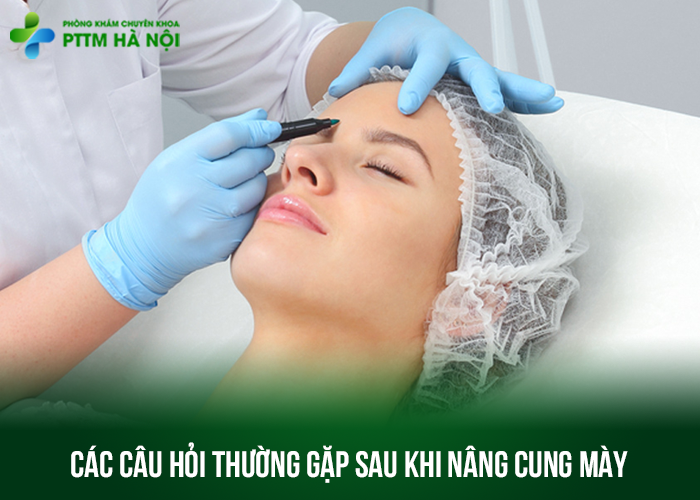Câu hỏi thường gặp sau nâng cung mày
