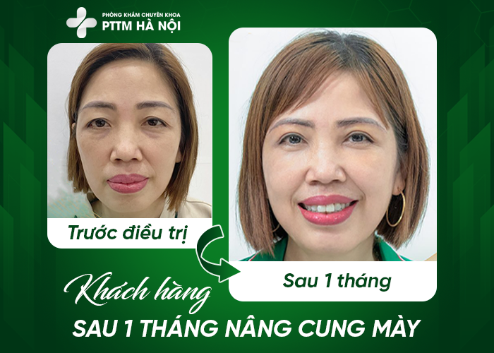 Kết quả sau 1 tháng nâng cung mày