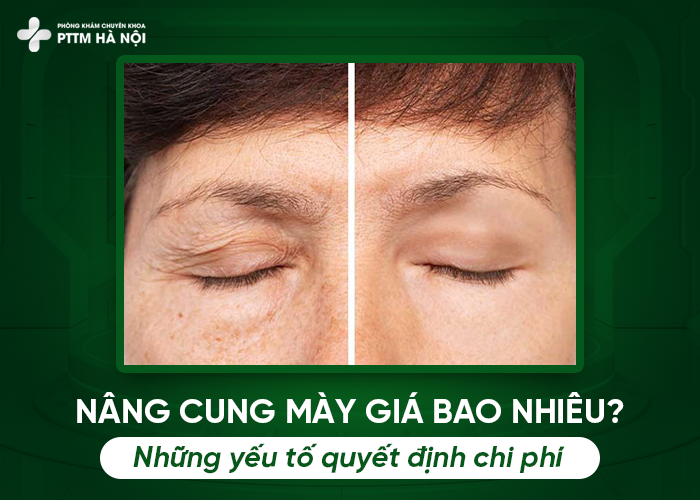 Nâng cung mày giá bao nhiêu, yếu tố quyết định chi phí