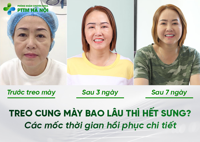 Treo cung mày bao lâu thì hết sưng, thời gian hồi phục chi tiết