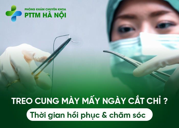 Treo cung mày bao nhiêu ngày thì cắt chỉ và hồi phục