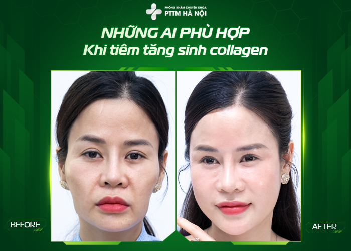 Hình ảnh trước và sau khi tiêm collagen Tiêu đề: Chú thích: Mô tả: