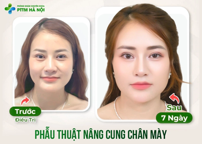 So sánh kết quả trước và sau 7 ngày nâng cung mày