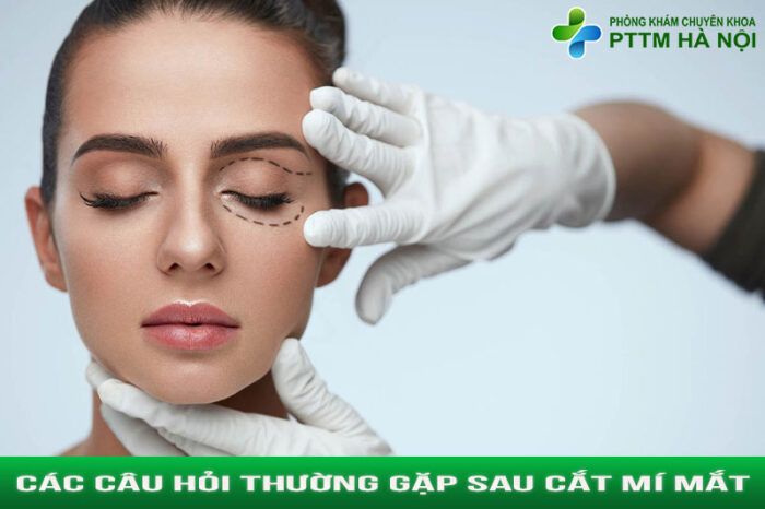 Mẫu minh họa với mí mắt đẹp tự nhiên – chủ đề các câu hỏi thường gặp sau cắt mí
