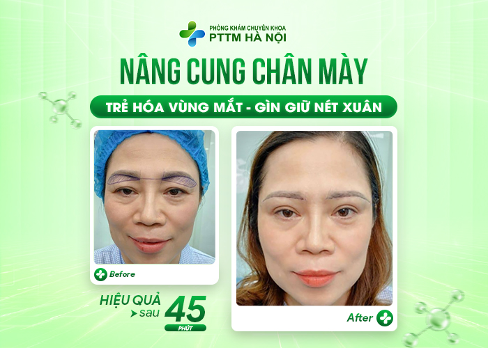 Hình ảnh khách hàng trước và sau khi nâng cung mày