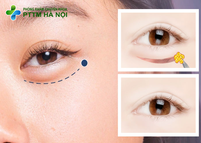 So sánh trước và sau khi thẩm mỹ mắt
