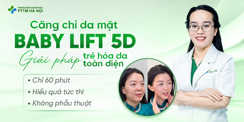 Căng chỉ da mặt Baby Lift 5D trước sau khách hàng thực hiện