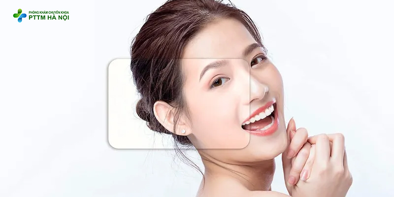 Kết quả căng chỉ da mặt giúp nâng cơ trẻ hóa