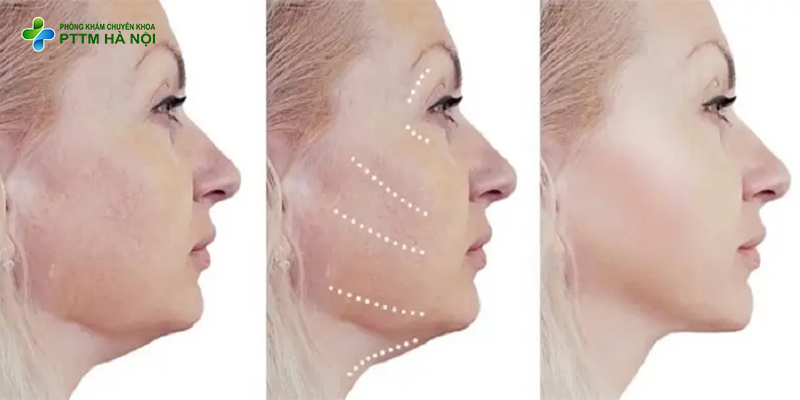 Mô phỏng kỹ thuật căng chỉ da mặt nâng cơ trẻ hóa