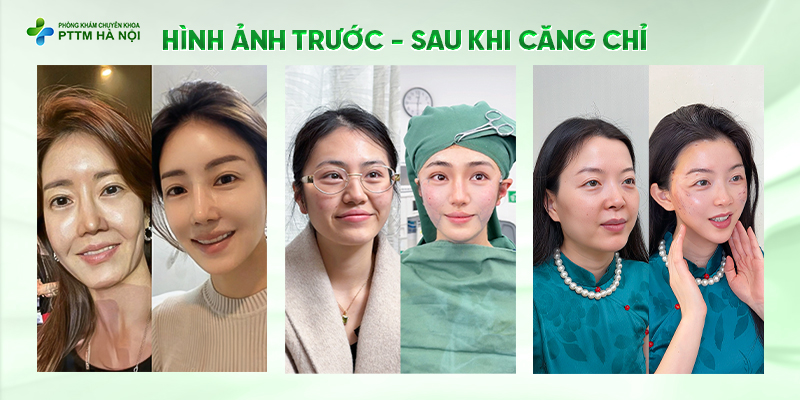 Hình ảnh trước sau căng chỉ da mặt cải thiện rõ rệt