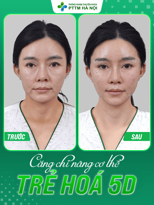 Căng chỉ da mặt – Giải pháp trẻ hóa da toàn điện không phẫu thuật