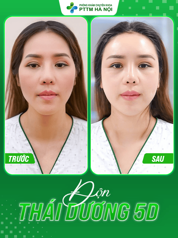 Độn thái dương – Giải pháp khắc phục thái dương hóp lõm hiệu quả