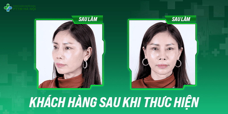 Khuôn mặt khách hàng đầy đặn và trẻ trung hơn sau khi độn thái dương