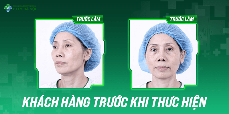 Khuôn mặt khách hàng với khuyết điểm thái dương lõm sâu trước khi làm phẫu thuật