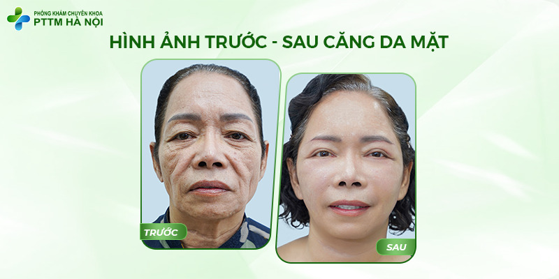 Sự thay đổi ngoạn mục trước và sau khi căng da mặt của khách hàng nữ lớn tuổi.