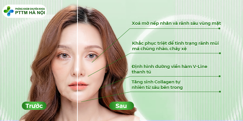 Kiểm chứng hiệu quả khi căng da mặt: xóa mờ nếp nhăn, khắc phục triệt để tình trạng rãnh mũi má chảy xệ, định hình V-Line và tăng sinh collagen tự nhiên.
